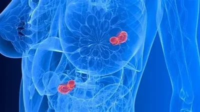 Cáncer de mama: ¿Cómo prevenirlo y detectarlo a tiempo?