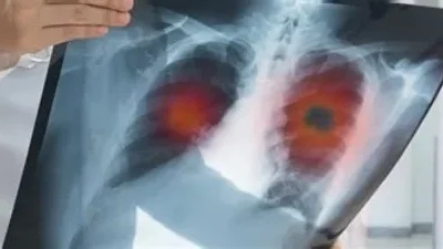 Cáncer de pulmón y Immunocal: ¿Puede esta proteína ayudar en la lucha contra la enfermedad?