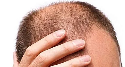 Cual es la causa de la calvicie descubriendo las posibles razones detrás de la pérdida del cabello.