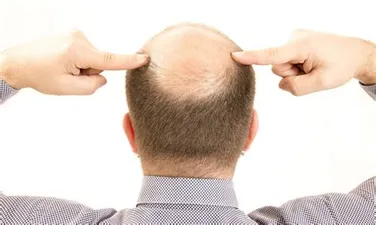 La Calvicie y su Relación con la 5 Alfa Reductasa