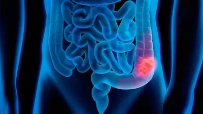 Todo lo que necesitas saber sobre el cáncer de colon