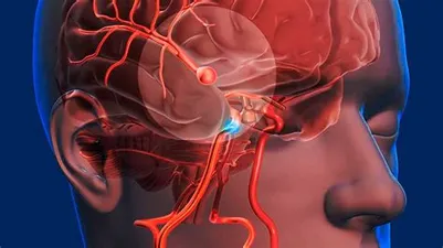 Todo lo que necesitas saber sobre los Aneurismas