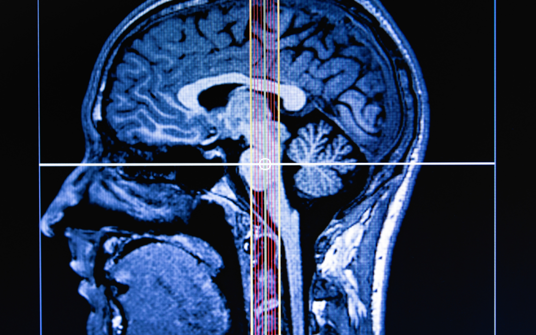 El Poder del Glutatión: Protegiendo el Cerebro de las Crisis Cerebrales