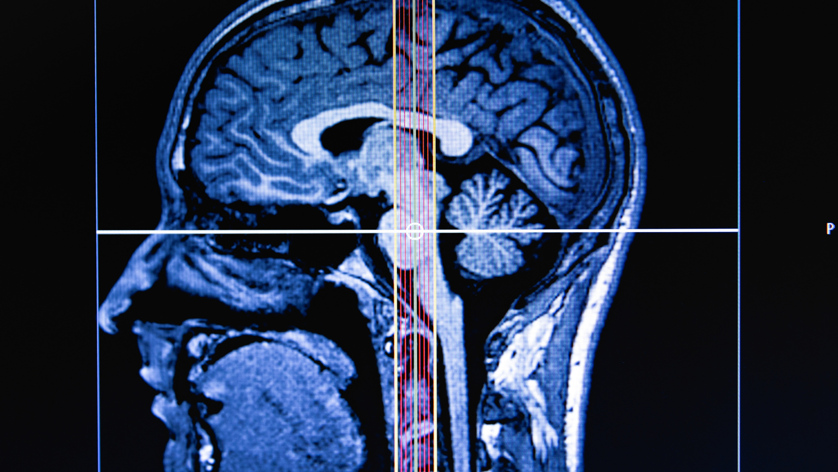 El Poder del Glutatión_ Protegiendo el Cerebro de las Crisis Cerebrales